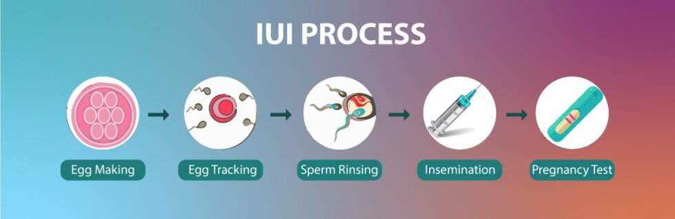 Iui Procedure Step By Step Intrauterine Insemination Dr Gunjan Gupta 9590